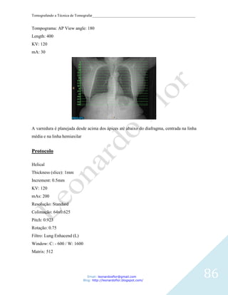 Tomografando a Técnica de Tomografar_______________________________________________________


Tompograma: AP View angle: 180
Length: 400
KV: 120
mA: 30




A varredura é planejada desde acima dos ápices até abaixo do diafragma, centrada na linha
média e na linha hemiaxilar


Protocolo

Helical
Thickness (slice): 1mm
Increment: 0.5mm
KV: 120
mAs: 200
Resolução: Standard
Colimação: 64x0.625
Pitch: 0.923
Rotação: 0.75
Filtro: Lung Enhacend (L)
Window: C: - 600 / W: 1600
Matrix: 512




                                 Email: leonardosflor@gmail.com
                              Blog: http://leonardoflor.blogspot.com/
                                                                                              86
 
