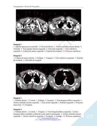Tomografando a Técnica de Tomografar_______________________________________________________




Imagem 1
1, Apófise (processo) coracóide. 2, Clavícula direita. 3, Artéria carótida comum direita. 4,
Tireóide. 5, Veia jugular interna esquerda. 6, Clavícula esquerda. 7, Veia subclávia
esquerda. 8, Cabeça do úmero esquerda. 9, Espinha da escápula. 10, Processo espinhoso.

Imagem 2
1, Cabeça do úmero direita. 2, Esôfago. 3, Traquéia. 4, Veia subclávia esquerda. 5, Espinha
da escápula. 6, Glenóide da escapula




Imagem 3
1, Pulmão direito. 2, Costela. 3, Esôfago. 4, Traquéia. 5, Veia braquiocefálica esquerda. 6,
Artéria carótida comum esquerda. 7, Veia axilar esquerda. 8, Pulmão esquerdo. 9, Processo
transverso. 10, Escápula.

Imagem 4
1, Pulmão direito. 2, Costela. 3, Traquéia. 4, Veia braquiocefálica esquerda. 5, tronco


                                                                                               87
braquiocefálico (também conhecido como artéria inominada). 6, Artéria carótida comum
esquerda. 7, Artéria subclávia esquerda. 8, Escápula. 9, Esôfago. 10, Processo espinhoso.
                                Email: leonardosflor@gmail.com
                             Blog: http://leonardoflor.blogspot.com/
 