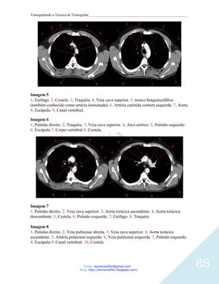 Tomografando a Técnica de Tomografar_______________________________________________________




Imagem 5
1, Esôfago. 2, Costela. 3, Traquéia. 4, Veia cava superior. 5, tronco braquiocefálico
(também conhecido como artéria inominada). 6, Artéria carótida comum esquerda. 7, Aorta.
8, Escápula. 9, Canal vertebral.

Imagem 6
1, Pulmão direito. 2, Traquéia. 3, Veia cava superior. 4, Arco aórtico. 5, Pulmão esquerdo.
6, Escápula 7, Corpo vertebral 8, Costela.




Imagem 7
1, Pulmão direito. 2, Veia cava superior. 3, Aorta torácica ascendente. 4, Aorta torácica
descendente. 5, Costela. 6, Pulmão esquerdo. 7, Esôfago. 8, Traquéia

Imagem 8
1, Pulmão direito. 2, Veia pulmonar direita. 3, Veia cava superior. 4, Aorta torácica
ascendente. 5, Artéria pulmonar esquerda. 6, Veia pulmonar esquerda. 7, Pulmão esquerdo.
8, Escápula 9, Canal vertebral. 10, Costela.




                                Email: leonardosflor@gmail.com
                             Blog: http://leonardoflor.blogspot.com/
                                                                                              88
 