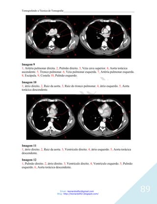 Tomografando a Técnica de Tomografar_______________________________________________________




Imagem 9
1, Artéria pulmonar direita. 2, Pulmão direito. 3, Veia cava superior. 4, Aorta torácica
ascendente. 5, Tronco pulmonar. 6, Veia pulmonar esquerda. 7, Artéria pulmonar esquerda.
8, Escápula. 9, Costela 10, Pulmão esquerdo.

Imagem 10
1, átrio direito. 2, Raiz da aorta. 3, Raiz do tronco pulmonar. 4, átrio esquerdo. 5, Aorta
torácica descendente.




Imagem 11
1, átrio direito. 2, Raiz da aorta. 3, Ventrículo direito. 4, átrio esquerdo. 5, Aorta torácica
descendente.

Imagem 12
1, Pulmão direito. 2, átrio direito. 3, Ventrículo direito. 4, Ventrículo esquerdo. 5, Pulmão
esquerdo. 6, Aorta torácica descendente.




                                 Email: leonardosflor@gmail.com
                              Blog: http://leonardoflor.blogspot.com/
                                                                                                  89
 