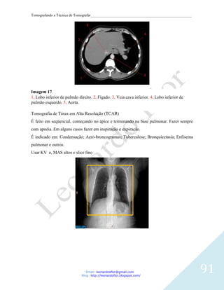 Tomografando a Técnica de Tomografar_______________________________________________________




Imagem 17
1, Lobo inferior de pulmão direito. 2, Fígado. 3, Veia cava inferior. 4, Lobo inferior de
pulmão esquerdo. 5, Aorta.

Tomografia de Tórax em Alta Resolução (TCAR)
É feito em seqüencial, começando no ápice e terminando na base pulmonar. Fazer sempre
com apnéia. Em alguns casos fazer em inspiração e expiração.
É indicado em: Condensação; Aero-broncogramas; Tuberculose; Bronquiectasia; Enfisema
pulmonar e outros.
Usar KV e, MAS altos e slice fino




                                Email: leonardosflor@gmail.com
                             Blog: http://leonardoflor.blogspot.com/
                                                                                              91
 