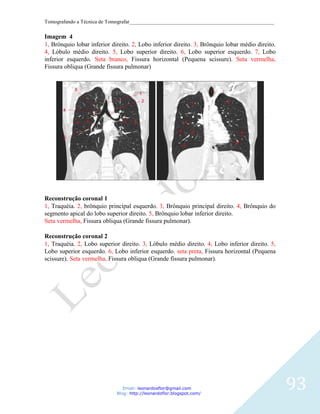 Tomografando a Técnica de Tomografar_______________________________________________________

Imagem 4
1, Brônquio lobar inferior direito. 2, Lobo inferior direito. 3, Brônquio lobar médio direito.
4, Lóbulo médio direito. 5, Lobo superior direito. 6, Lobo superior esquerdo. 7, Lobo
inferior esquerdo. Seta branco, Fissura horizontal (Pequena scissure). Seta vermelha,
Fissura obliqua (Grande fissura pulmonar)




Reconstrução coronal 1
1, Traquéia. 2, brônquio principal esquerdo. 3, Brônquio principal direito. 4, Brônquio do
segmento apical do lobo superior direito. 5, Brônquio lobar inferior direito.
Seta vermelha, Fissura obliqua (Grande fissura pulmonar).

Reconstrução coronal 2
1, Traquéia. 2, Lobo superior direito. 3, Lóbulo médio direito. 4, Lobo inferior direito. 5,
Lobo superior esquerdo. 6, Lobo inferior esquerdo. seta preta, Fissura horizontal (Pequena
scissure). Seta vermelha, Fissura obliqua (Grande fissura pulmonar).




                                Email: leonardosflor@gmail.com
                             Blog: http://leonardoflor.blogspot.com/
                                                                                                 93
 