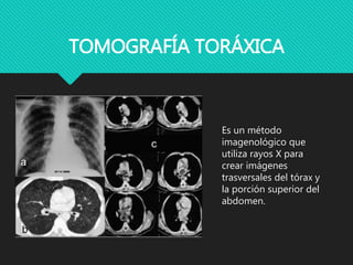 TOMOGRAFÍA TORÁXICA
Es un método
imagenológico que
utiliza rayos X para
crear imágenes
trasversales del tórax y
la porción...