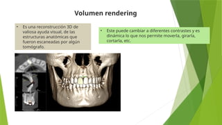 • Es una reconstrucción 3D de
valiosa ayuda visual, de las
estructuras anatómicas que
fueron escaneadas por algún
tomógrafo.
Volumen rendering
• Este puede cambiar a diferentes contrastes y es
dinámica lo que nos permite moverla, girarla,
cortarla, etc.
 