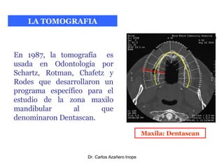 LA TOMOGRAFIA En 1987, la tomografía  es usada en Odontología por Schartz, Rotman, Chafetz y Rodes que desarrollaron un programa específico para el estudio de la zona maxilo mandibular al que denominaron Dentascan. Maxila: Dentascan 