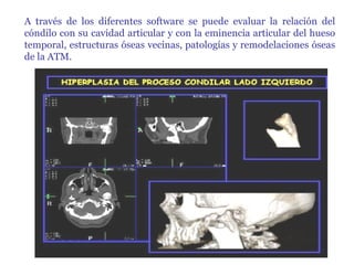 A través de los diferentes software se puede evaluar la relación del cóndilo con su cavidad articular y con la eminencia articular del hueso temporal, estructuras óseas vecinas, patologías y remodelaciones óseas de la ATM.  