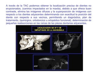 A través de la TAC podemos obtener la localización precisa de dientes no erupcionados, (caninos impactados en la maxila), debido a que ofrece buen contraste, elimina las imágenes difusas y la superposición de imágenes con respecto a los dientes adyacentes determinando con exactitud la posición del diente con respecto a sus vecinos, permitiendo un diagnóstico, plan de tratamiento, (quirúrgico, ortodoncico u ortopédico funcional), determinación de pequeñas reabsorciones en las raíces de las piezas dentarias adyacentes.  