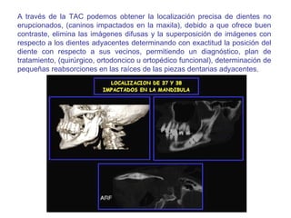 Tomografia Computarizada