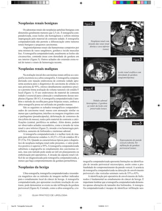 Neoplasias renais benignas                                            Figura   2
               Os adenomas renais são neoplasias epiteliais benignas com
         dimensões geralmente menores que 2,5 cm. À tomografia com-
         putadorizada, essas lesões são homogêneas e sofrem mínima
         impregnação pelo material de contraste iodado. A tomografia
         computadorizada não permite a diferenciação entre tumores                    Neoplasia renal com
         renais benignos e pequenos carcinomas.                                    invasão das veias renal
                                                                                     direita e cava inferior
               Angiomiolipomas renais são hamartomas compostos por
                                                                                                    (setas).
         uma mistura de vasos sangüíneos, gordura e tecido muscular
         liso. À tomografia computadorizada, usualmente as lesões são
         circunscritas, contendo áreas com densidade de gordura em
         seu interior (figura 3). Outros achados são extensão extra-re-                                                          Figura   3
         nal do tumor e sinais de hemorragia recente.

         Neoplasias renais malignas
                                                                                                                 Lesão renal exofítica com
               Na avaliação inicial dos carcinomas renais utiliza-se a uro-                                      densidade de gordura
         grafia excretora ou a ultra-sonografia. A tomografia computa-                                           (angiomiolipoma).
         dorizada com injeção endovenosa de contraste iodado apre-
         senta acurácia para o diagnóstico do carcinoma de células re-
         nais próxima de 95%, oferece detalhamento anatômico preci-
         so e permite ótima avaliação do volume tumoral e do estádio T         Figura   4
         local (figura 1). O uso endovenoso do material de contraste
         iodado é essencial para a detecção e estadiamento dessas neo-
         plasias (figuras 1B-1C). A tomografia computadorizada é tam-
         bém o método de escolha para guiar biópsias renais, embora a                   Nódulo adrenal
                                                                                 heterogêneo. A gordura
         ultra-sonografia possa ser utilizada em grandes massas.
                                                                                  ao redor da lesão está
               São os seguintes os achados tomográficos computadori-                 preservada (setas).
         zados do carcinoma renal: massa com atenuação similar ou
         menor que o parênquima, interface ou margens irregulares com
         o parênquima (pseudocápsula), deformação de contornos do
         rim (efeito de massa), realce pelo material de contraste e calci-
         ficações (central, periférica ou ambas). Além destes, podem
         ser observados achados secundários, como a invasão de veias
                                                                                                                                 Figura   5
         renal e cava inferior (figura 2), invasão e/ou hemorragia peri-
         nefrética, aumento de linfonodos e metástase adrenal.
               A tomografia computadorizada é o melhor teste de ima-
         gem para diferenciar estádios I e II (T1 e T2) de estádios III e
         IV (T3a-T4). Quando as características típicas para o diagnós-                                           Espessamento de parede
         tico de neoplasia maligna renal estão presentes, o valor predi-                                          vesical à direita. Ver
         tivo positivo é superior a 95%. A tomografia computadorizada                                             infiltração de gordura
         substituiu a angiografia no estadiamento dos carcinomas re-                                              perivesical (setas).
         nais, mas este método pode ainda ser útil em planejamento ou
         embolização pré-operatórios. A invasão da cápsula renal é di-
         fícil de ser diagnosticada pela tomografia computadorizada, a
         menos que haja comprometimento da gordura perinefrética.             mografia computadorizada apresenta limitações na identifica-
                                                                              ção de invasão perivesical microscópica, assim como a pro-
         Neoplasias da bexiga                                                 fundidade do comprometimento da parede vesical. A acurácia
                                                                              da tomografia computadorizada na detecção do envolvimento
               Ultra-sonografia, tomografia computadorizada e ressonân-       perivesical e das vesículas seminais varia de 55% a 85%.
         cia magnética são os métodos de imagem melhor indicados                   A identificação pré-operatória de envolvimento de linfo-
         para o estadiamento local do câncer de bexiga. A tomografia          nodos é fundamental no estadiamento do câncer de bexiga. É
         computadorizada, por apresentar excelente resolução de con-          importante lembrar que a tomografia computadorizada demons-
         traste, pode demonstrar se existe ou não infiltração da gordura      tra apenas alterações de tamanho dos linfonodos. A tomogra-
         perivesical (figura 4). Contudo, como a ultra-sonografia, a to-      fia computadorizada é incapaz de identificar infiltração neo-


         24                GUIA PRÁTICO DE UROLOGIA



Cap 05 - Tomografia Comp.pm6       24                                                         13/06/00, 13:11
 