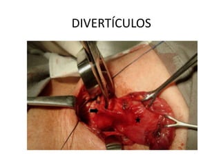 DIVERTÍCULOS
 