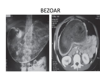 BEZOAR
 