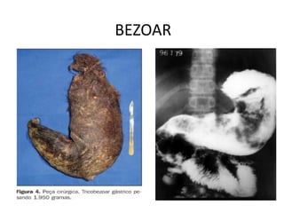 BEZOAR
 