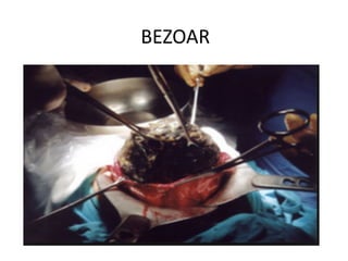 BEZOAR
 