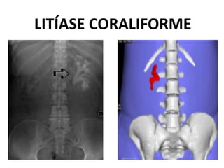LITÍASE CORALIFORME
 