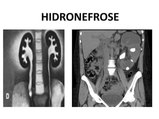 HIDRONEFROSE
 