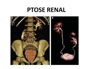 PTOSE RENAL
 