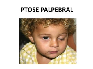 PTOSE PALPEBRAL
 