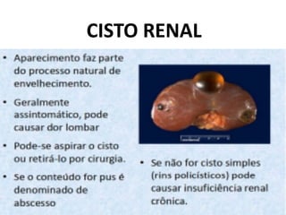 CISTO RENAL
 