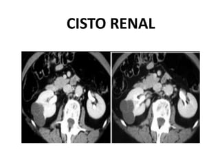 CISTO RENAL
 