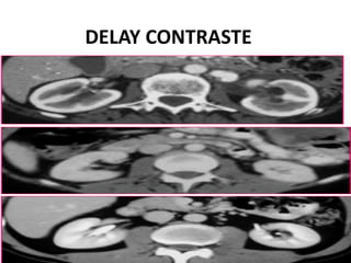 DELAY CONTRASTE
 