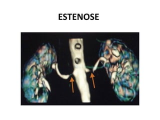 ESTENOSE
 