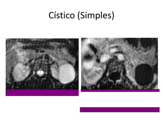 Cístico (Simples)
 