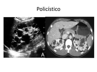 Policístico
 