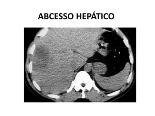 ABCESSO HEPÁTICO
 