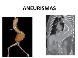 ANEURISMAS
 