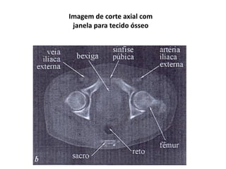 Imagem de corte axial com
janela para tecido ósseo
 