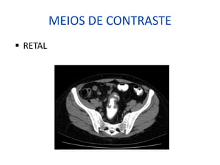 MEIOS DE CONTRASTE
§ RETAL
 
