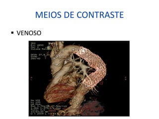 MEIOS DE CONTRASTE
§ VENOSO
 