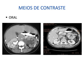 MEIOS DE CONTRASTE
§ ORAL
 