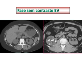 Fase sem contraste EV
 