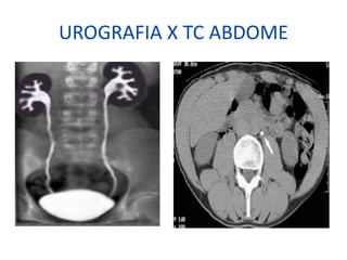 UROGRAFIA X TC ABDOME
 