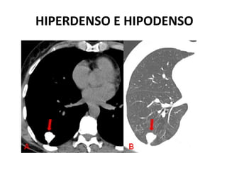 HIPERDENSO E HIPODENSO
 