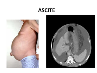 ASCITE
 