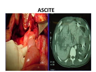 ASCITE
 