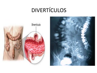 DIVERTÍCULOS
 