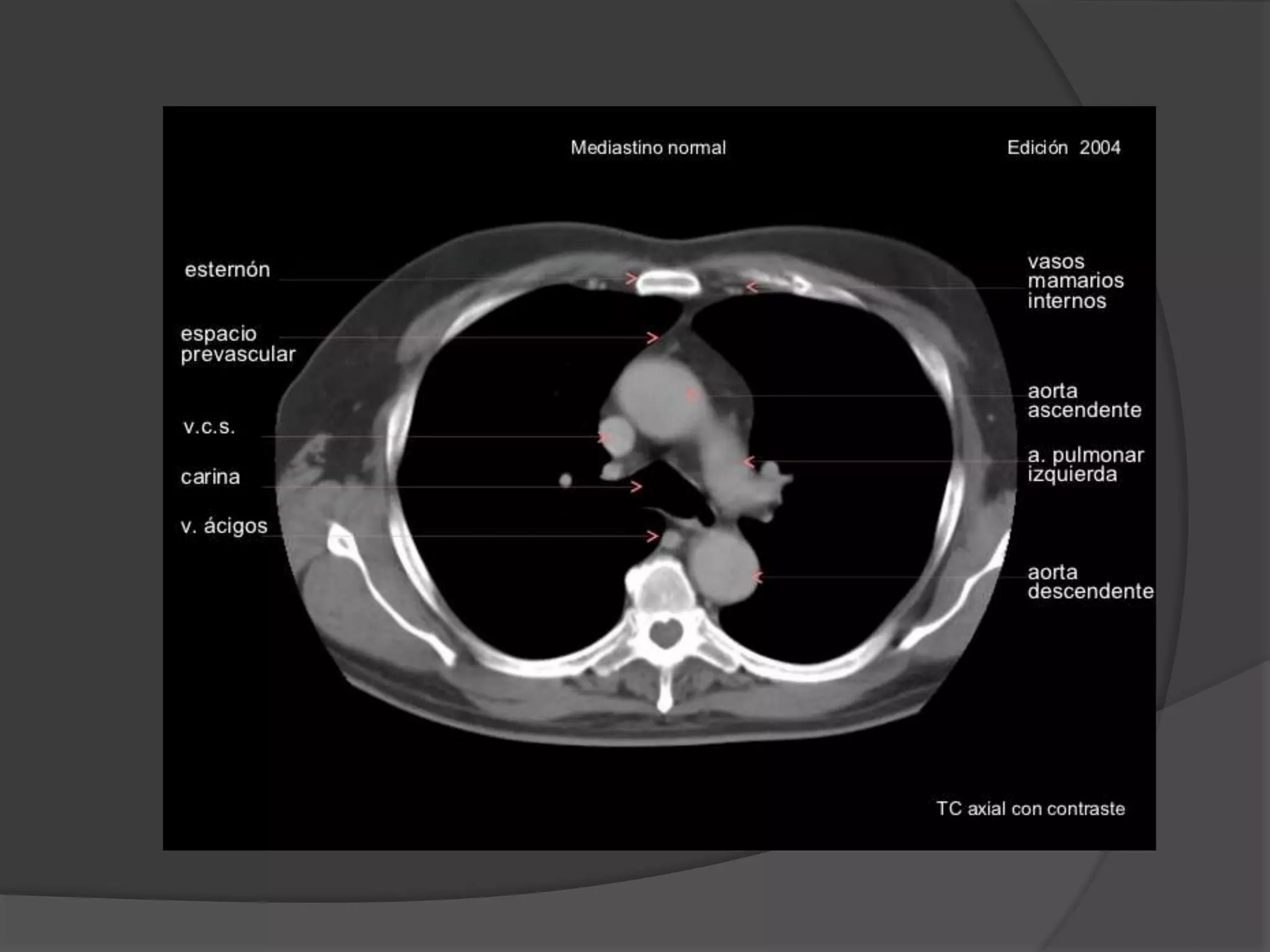 Torax Simple Tomografia anatomia de torax | PPTX