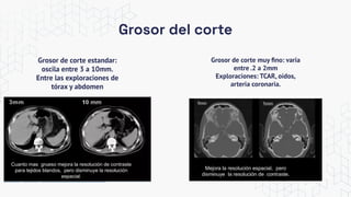 Grosor del corte
Grosor de corte muy ﬁno: varia
entre .2 a 2mm
Exploraciones: TCAR, oidos,
arteria coronaria.
Grosor de corte estandar:
oscila entre 3 a 10mm.
Entre las exploraciones de
tórax y abdomen
 