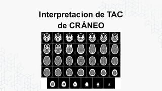 Interpretacion de TAC
de CRÁNEO
 