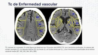 Tc de Enfermedad vascular
TC craneal sin contraste. En esta figura se observan los 10 puntos del ASPECTS, los 4 territorios profundos, la cabeza del
núcleo caudado (C), la cápsula interna (CI), la ínsula (I) y el núcleo lenticular (L), y los 6 territorios superficiales de la arteria
cerebral media (M1, M2, M3, M4, M5 y M6)
 