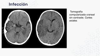 Infección
Tomografía
computarizada craneal
sin contraste. Cortes
axiales
 