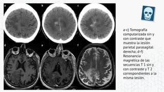 a-c) Tomografía
computarizada sin y
con contraste que
muestra la lesión
parietal parasagital
derecha; d-f)
Resonancia
magnética de las
secuencias T 1 sin y
con contraste y T 2
correspondientes a la
misma lesión.
 
