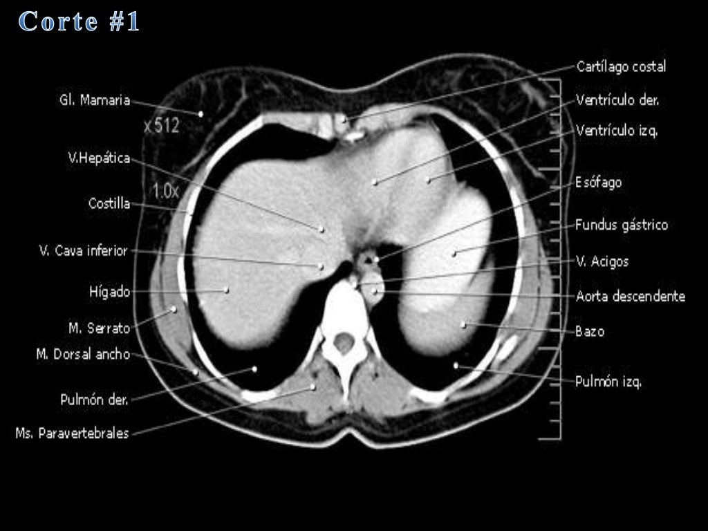 Tomografia Axial Computarizada abdominal 