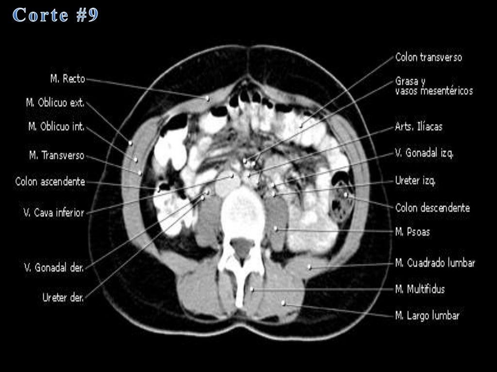 Tomografia Axial Computarizada abdominal 
