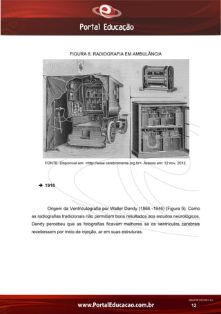 AN02FREV001/REV 4.0
12
FIGURA 8. RADIOGRAFIA EM AMBULÂNCIA
FONTE: Disponível em: <http://www.cerebromente.org.br>. Acesso em: 12 nov. 2012.
 1918
Origem da Ventriculografia por Walter Dandy (1866 -1946) (Figura 9). Como
as radiografias tradicionais não permitiam bons resultados aos estudos neurológicos,
Dendy percebeu que as fotografias ficavam melhores se os ventrículos cerebrais
recebessem por meio de injeção, ar em suas estruturas.
 