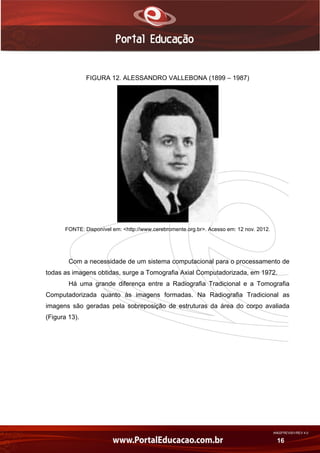 AN02FREV001/REV 4.0
16
FIGURA 12. ALESSANDRO VALLEBONA (1899 – 1987)
FONTE: Disponível em: <http://www.cerebromente.org.br>. Acesso em: 12 nov. 2012.
Com a necessidade de um sistema computacional para o processamento de
todas as imagens obtidas, surge a Tomografia Axial Computadorizada, em 1972.
Há uma grande diferença entre a Radiografia Tradicional e a Tomografia
Computadorizada quanto às imagens formadas. Na Radiografia Tradicional as
imagens são geradas pela sobreposição de estruturas da área do corpo avaliada
(Figura 13).
 