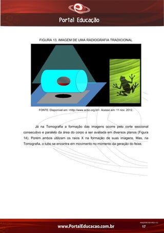 AN02FREV001/REV 4.0
17
FIGURA 13. IMAGEM DE UMA RADIOGRAFIA TRADICIONAL
FONTE: Disponível em: <http://www.acbo.org.br>. Acesso em: 11 nov. 2012.
Já na Tomografia a formação das imagens ocorre pelo corte seccional
consecutivo e paralelo da área do corpo a ser avaliada em diversos planos (Figura
14). Porém ambos utilizam os raios X na formação de suas imagens. Mas, na
Tomografia, o tubo se encontra em movimento no momento da geração do feixe.
 